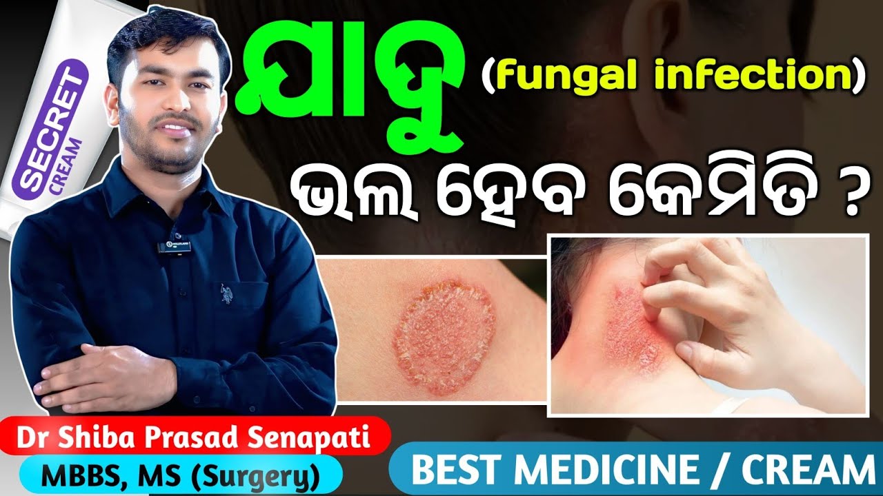 ଯାଦୁ ଭଲ ହେବ କେମିତି#odiahealthtips#fungalinfections