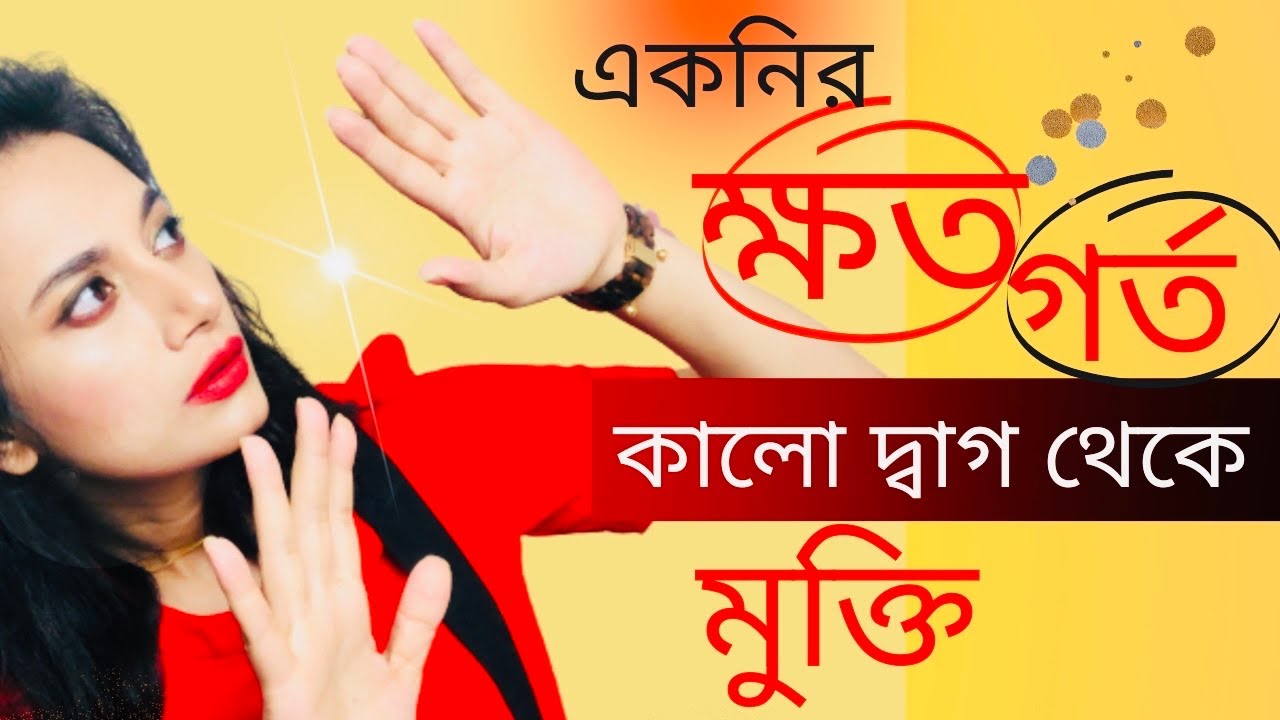 একনির গর্ত ও স্পট দূর করার উপায়/How to Remove Acne Scars? Which Product will Remove Acne Scars
