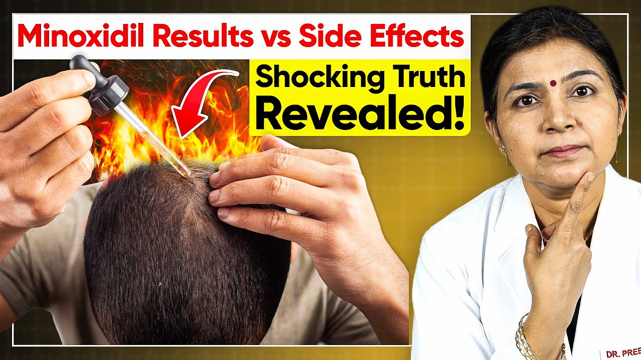 Minoxidil Results vs Side Effects - Before & After Minoxidil Results | Minoxidil Hair Regrowth