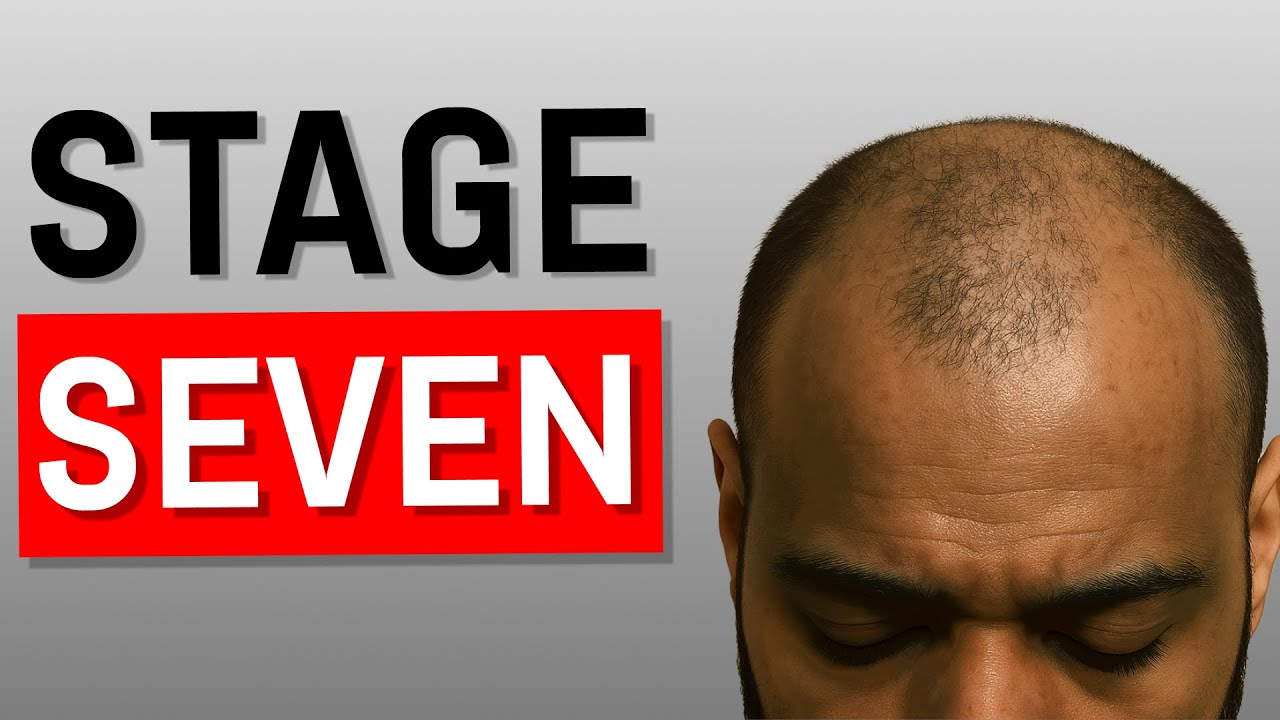 Do This EVERY Stage of Hair Loss (Complete Guide)