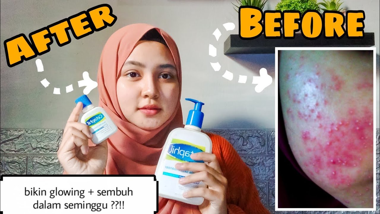 REVIEW CETAPHIL GENTLE SKIN CLEANSER DI KULIT SENSITIF BERJERAWAT| Jerawat & Bruntusan sembuh 😍