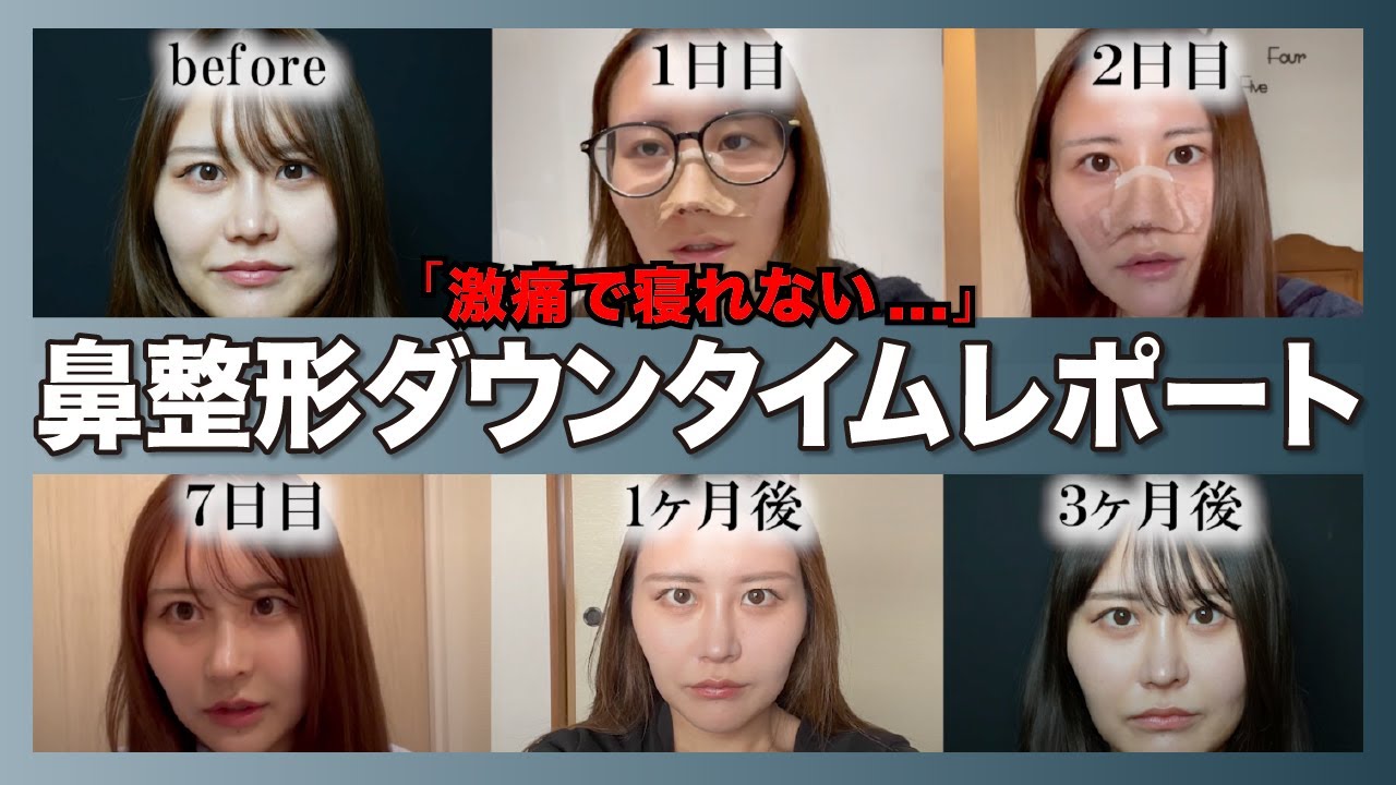 激痛すぎて寝れない…💥　術後1ヶ月までのダウンタイムレポート