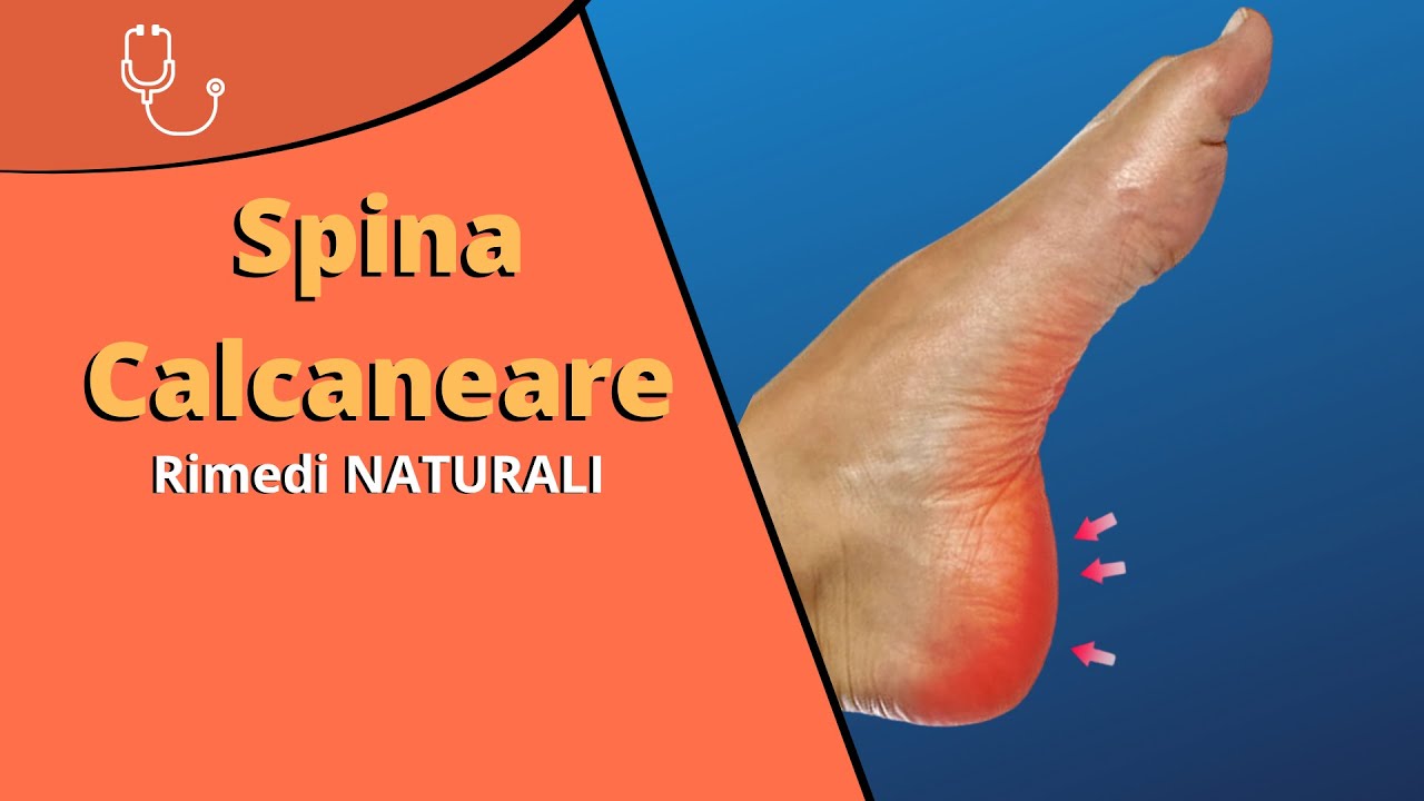 Spina Calcaneare Rimedi naturali