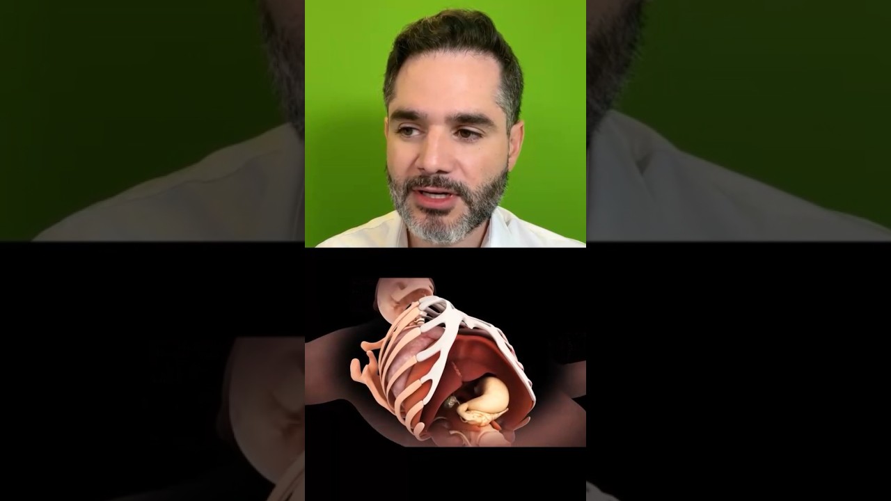 Como é feita a cirurgia do Pectus Carinatum com as barras?? #pectus #pectuscarinatum