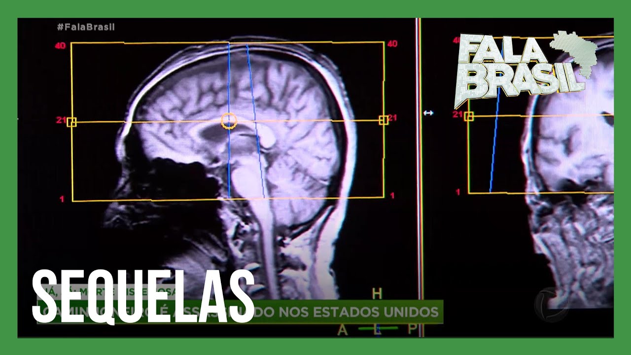 Pesquisa inédita mostra sequelas da covid-19 no cérebro
