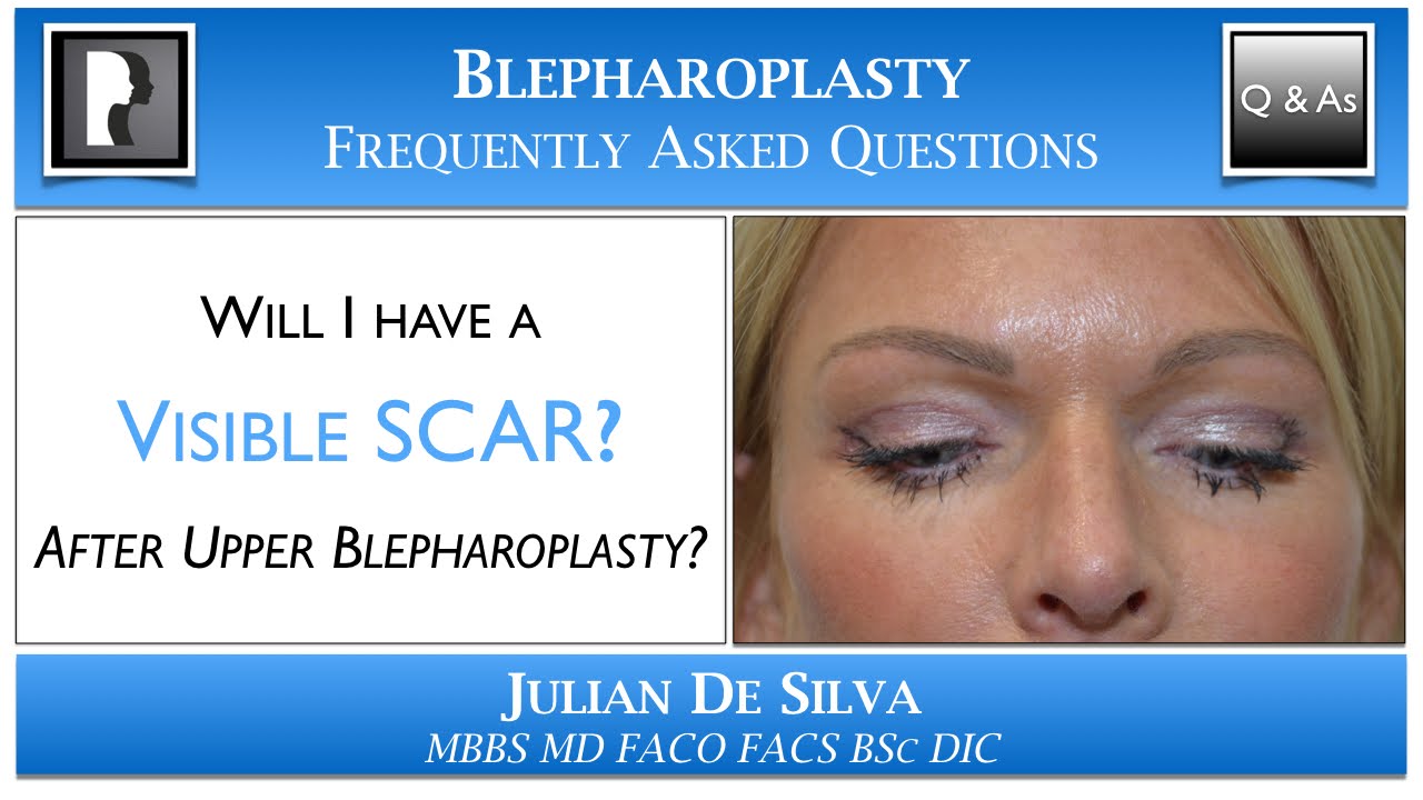 Will I have a Visible Scar after Upper Blepharoplasty? Scar after an upper eyelid lift?