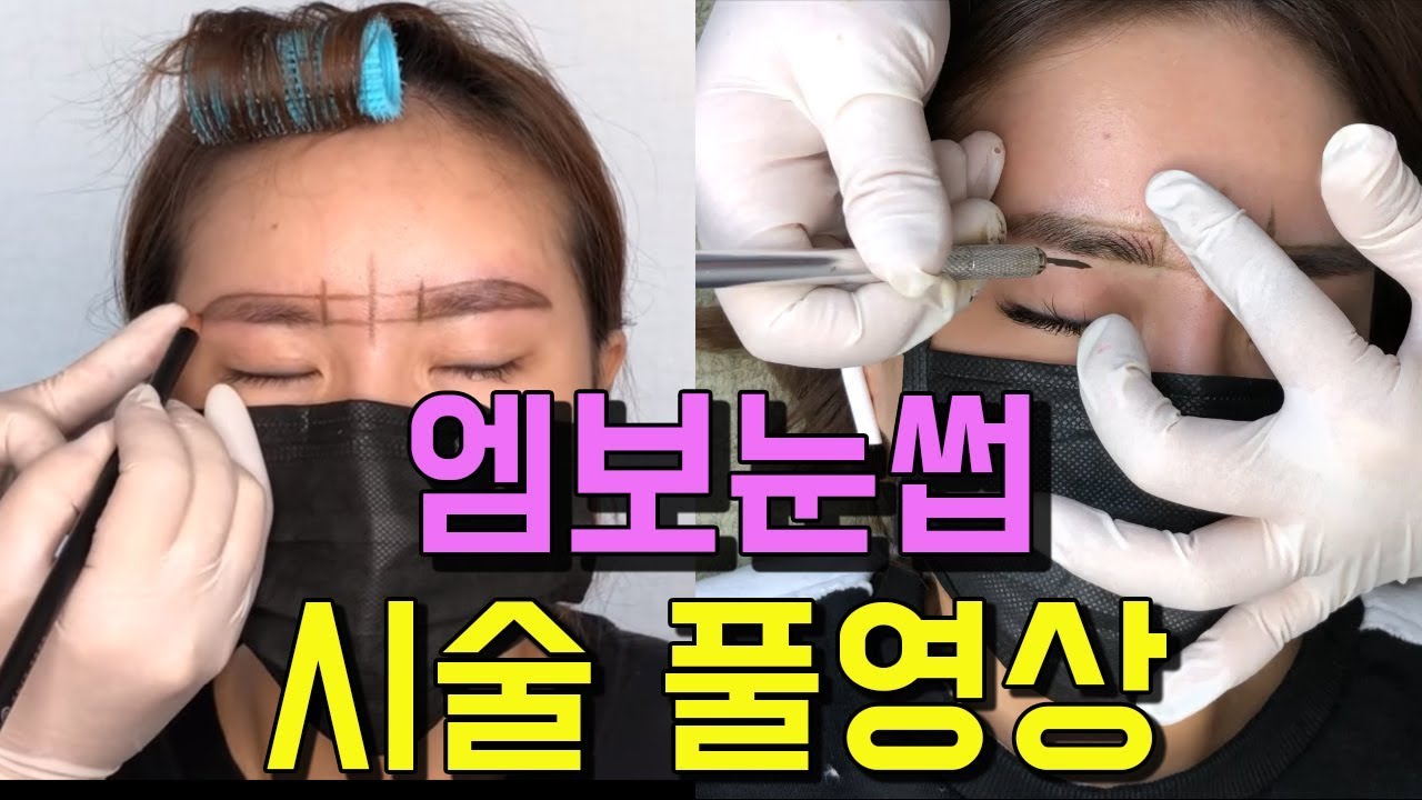 (콤보 2차) 엠보 시술풀영상