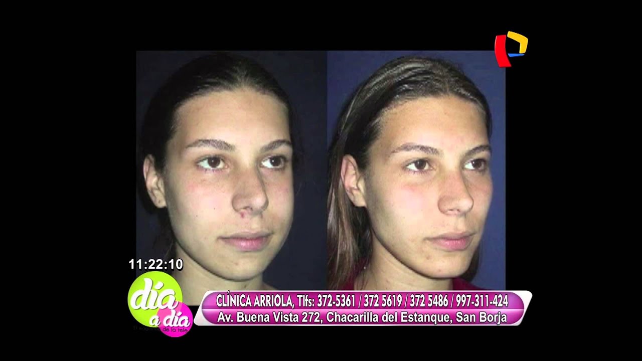 Afinamiento de rostro - Clínica Arriola