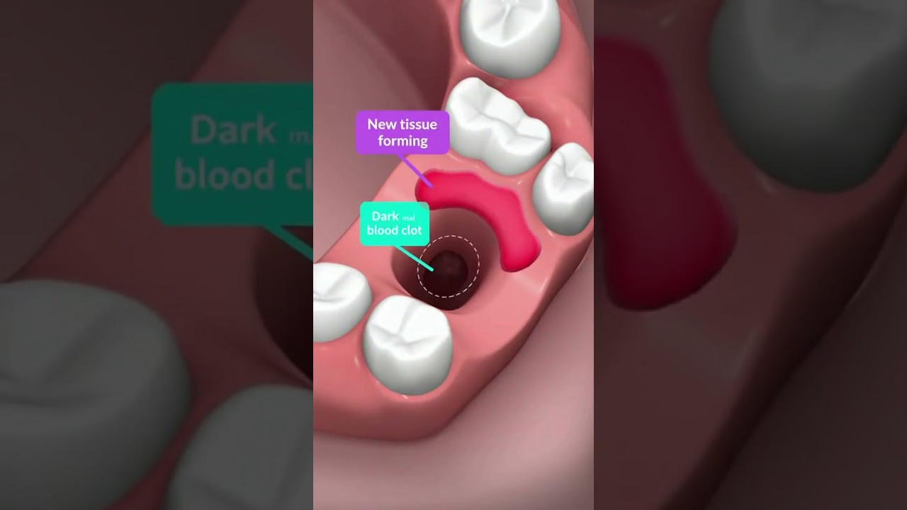 🦷 What Does a Normal Tooth Extraction Socket Look Like?