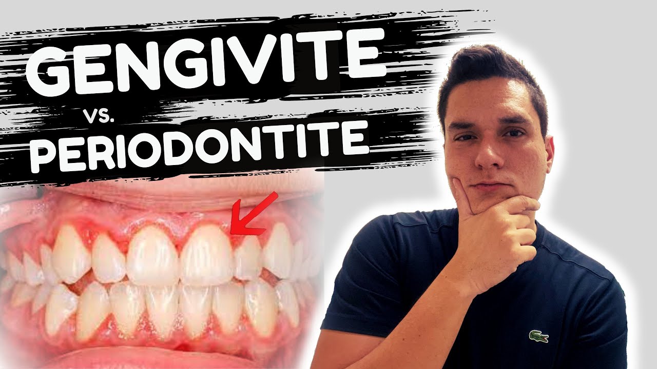 Gengivite x Periodontite: Diferentes Estágios da Doença Gengival!