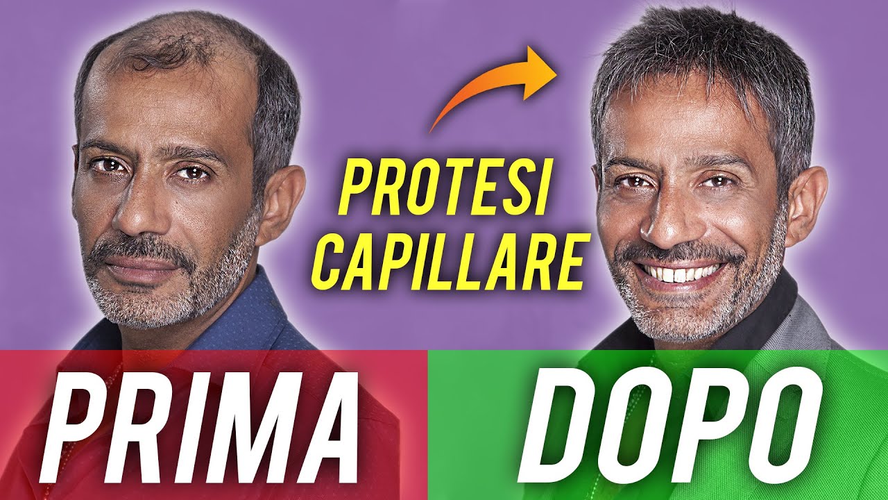 LA PROTESI MI HA CAMBIATO LA VITA - la storia di SIMONE FRATINI