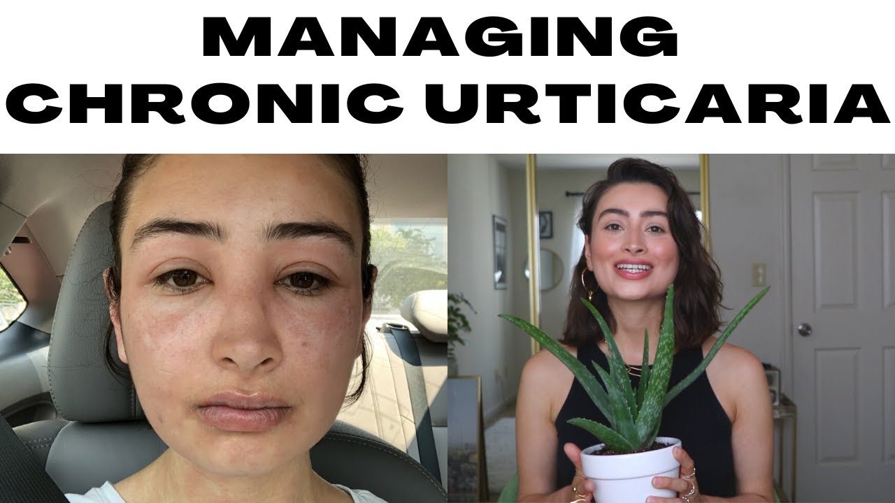 How I Manage Chronic Urticaria Flareups | Chronic Hives | Food & Chemical Sensitivities