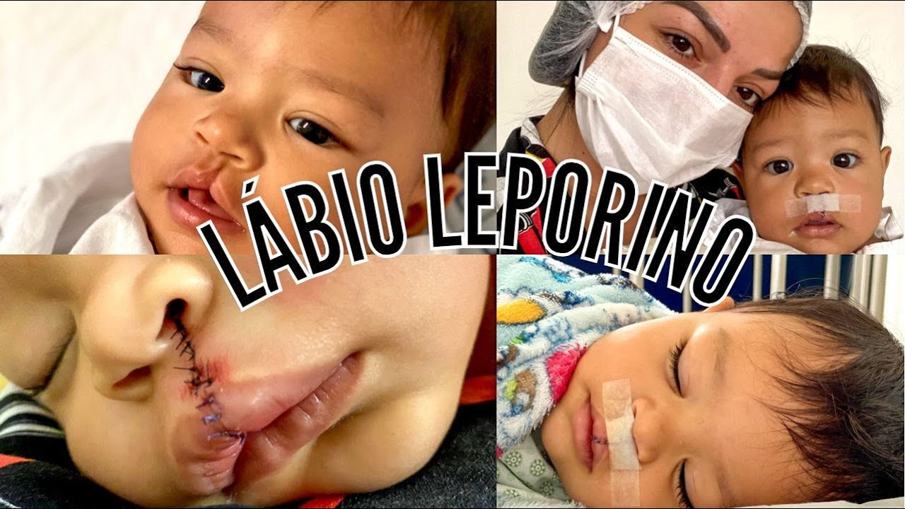 LÁBIO LEPORINO - CIRURGIA E RECUPERAÇÃO - SOBRAPAR UNICAMP