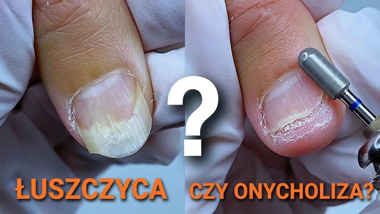 Psoriaza paznokci? Sprawdź, czym jest onycholiza