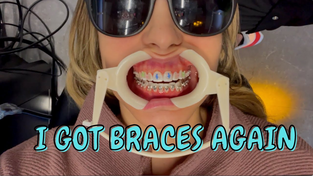 I got braces...again!