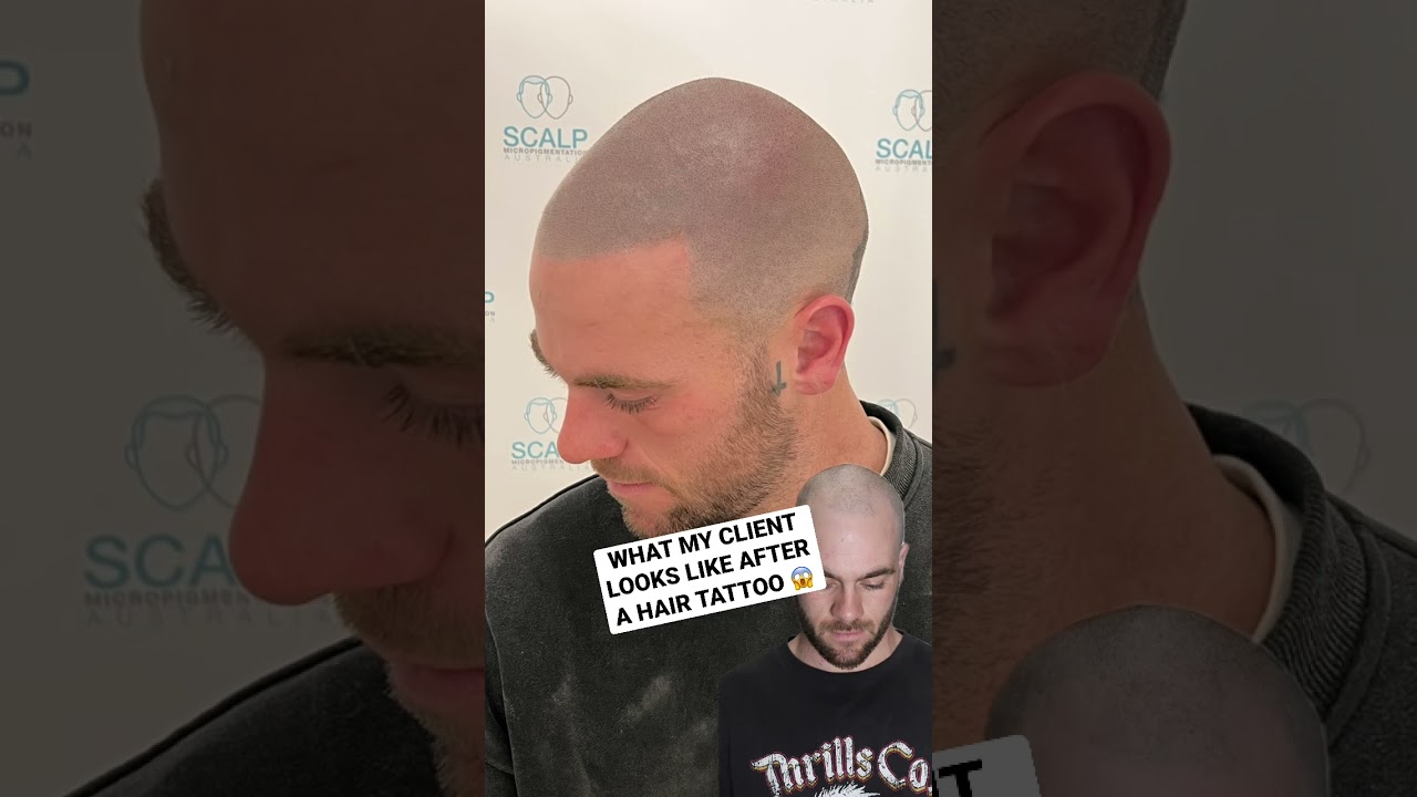 Hair Loss Transformation! #hairloss #scalpmicropigmentation #smp #beforeandafter #hairtattoo #hair