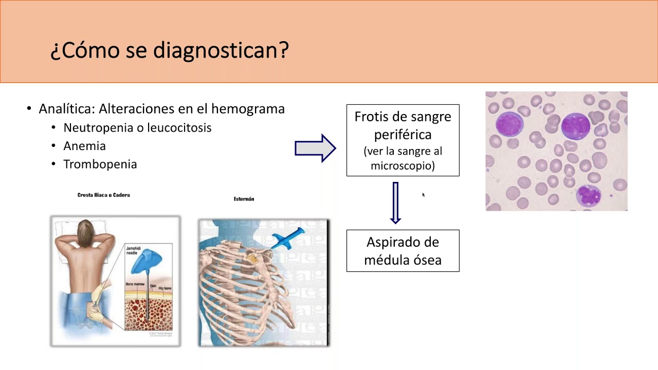 Leucemia Mieloide Aguda - Seminario online de la SEMOH 2018 (25-06-2018)