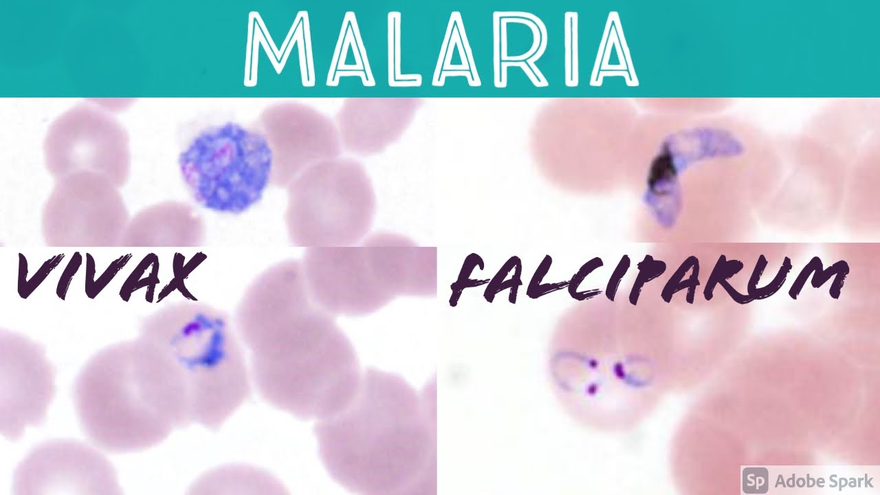 Мазок крови при малярии: Plasmodium falciparum против vivax (кольцо для наушников, трофозоит, бан...