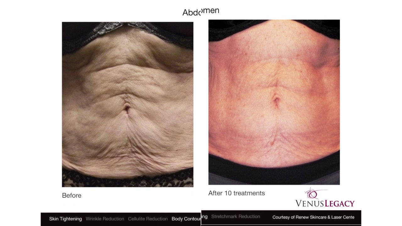 Venus Legacy Treatment  Before & After - Women's Abdomen