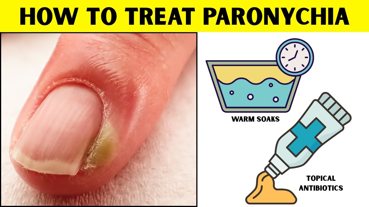How To Treat Paronychia?