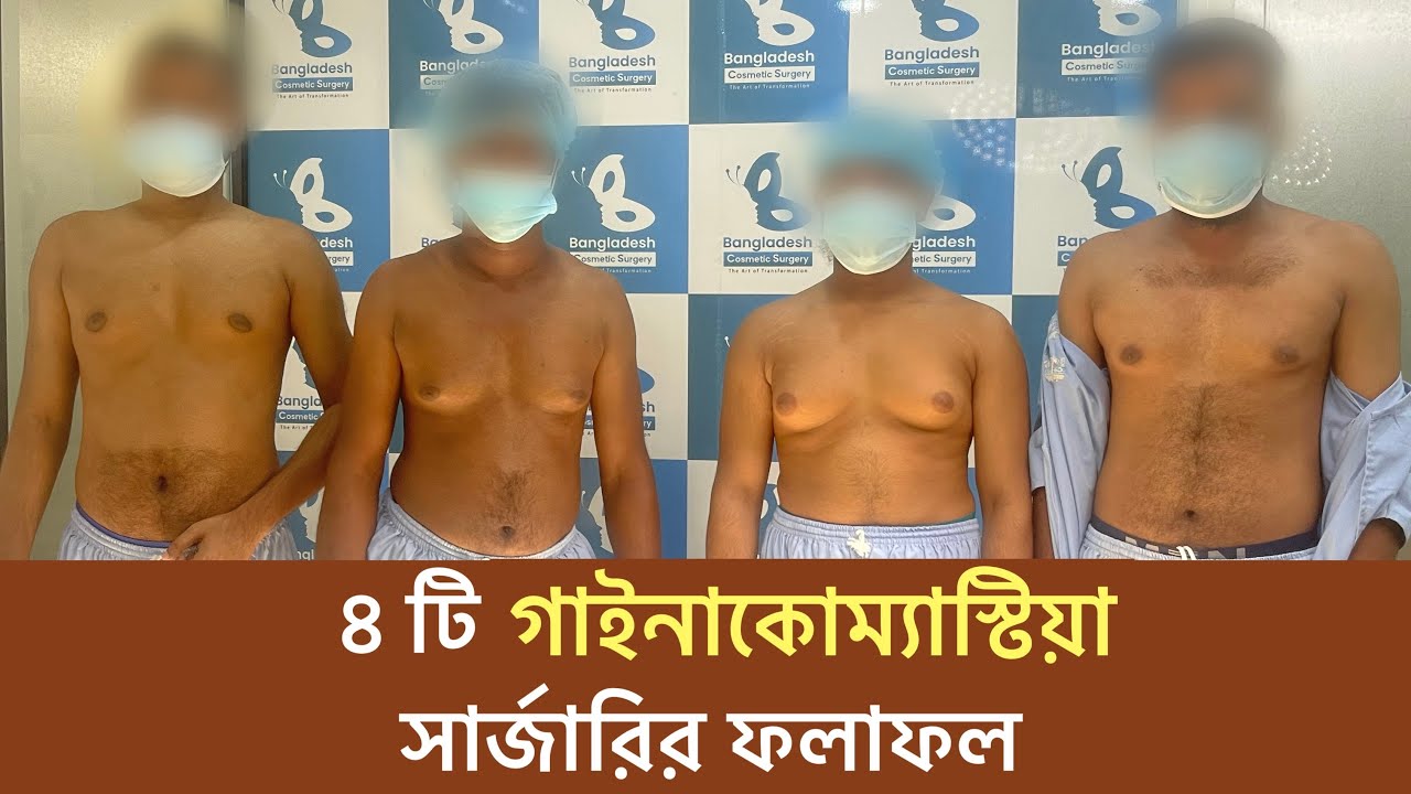 Gynecomastia surgery result | Gynaecomastia surgery in Bangladesh | Dr. Iqbal Ahmed plastic surgery