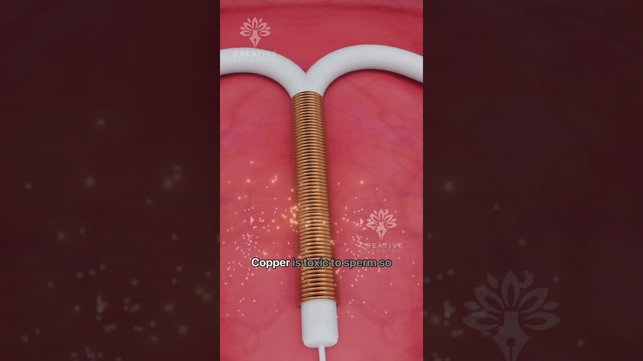 What Happens Inside Your Body After Copper T - Intrauterine Device (IUD) #shorts #pregnancy