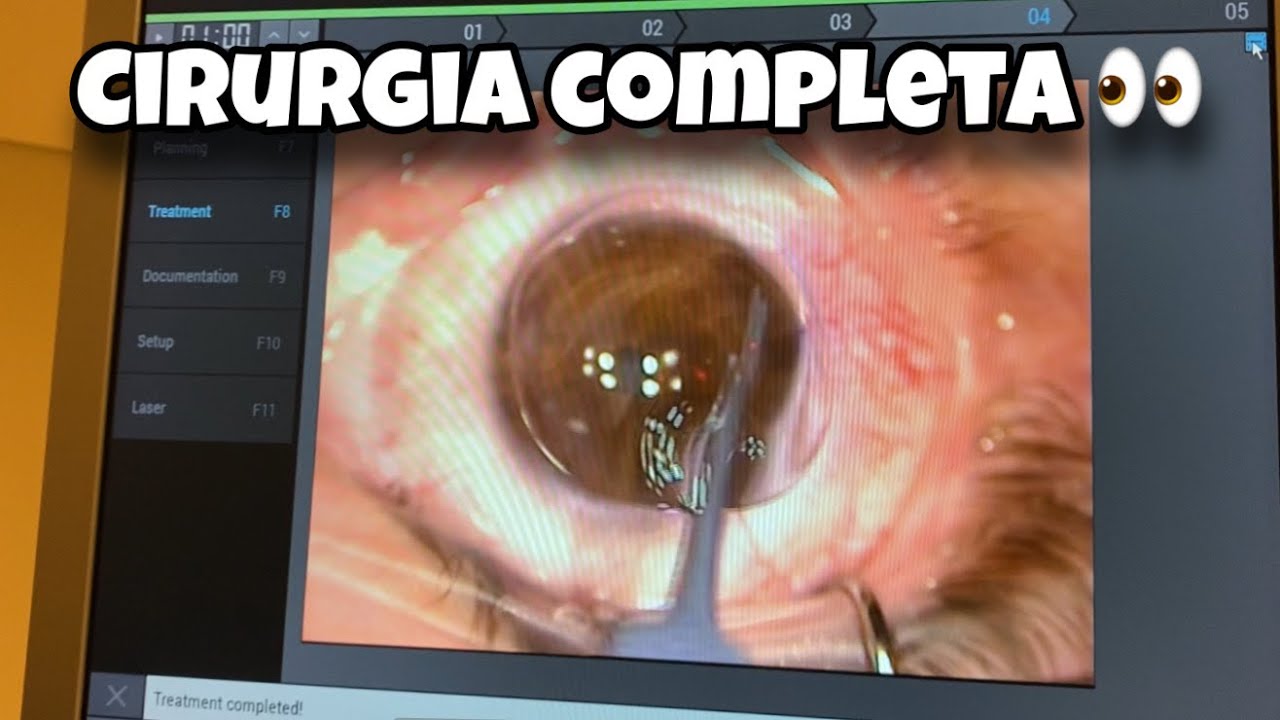 Cirurgia refrativa completa, lasik 👀