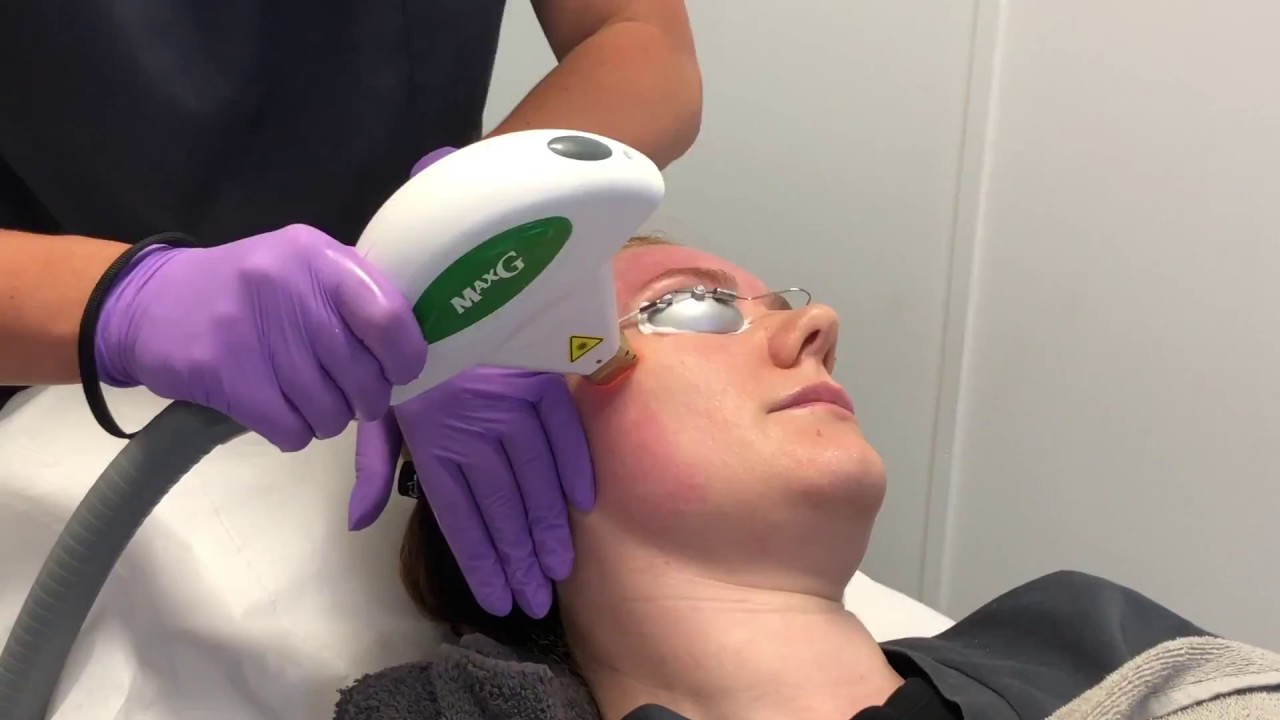 Cynosure ICON MAXG IPL Treatment | The Laser and Skin Clinic