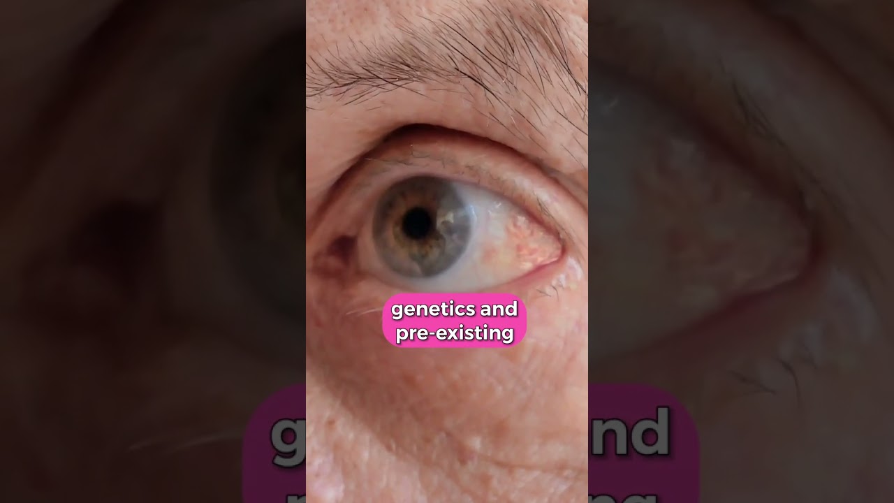 Glaucoma: The Silent Thief of Sight &ndash; 4 Facts You Must Know 👀 #glaucoma #glaucomaawareness