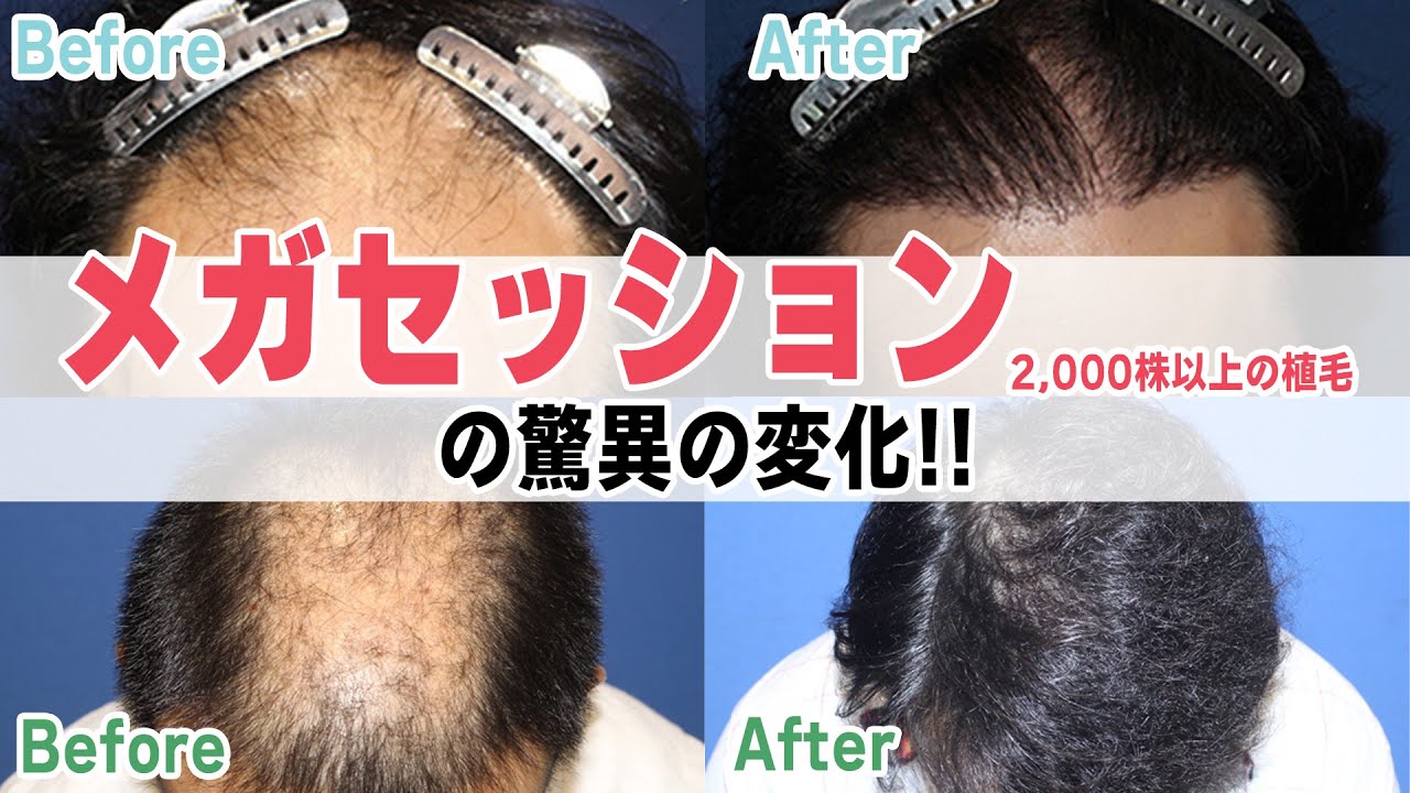 【自毛植毛】メガセッション、2000株以上の自毛植毛症例について、薄毛治療の専門医が解説いたします。