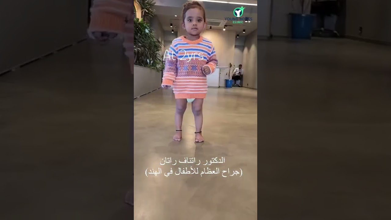 Clubfoot journey|CTEV Bilateral|Cubfoot miracle|Dr Ratnav Ratan