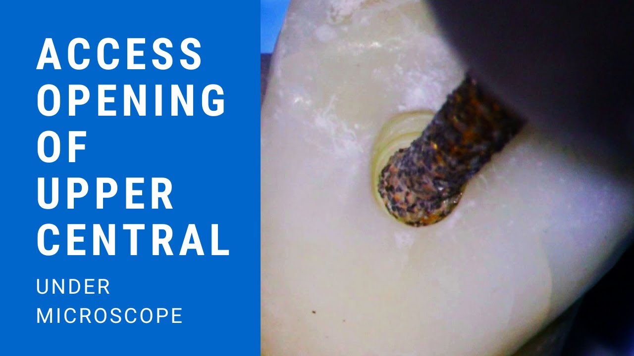 Access opening of Upper Central Incisor under Microscope | Aspire32