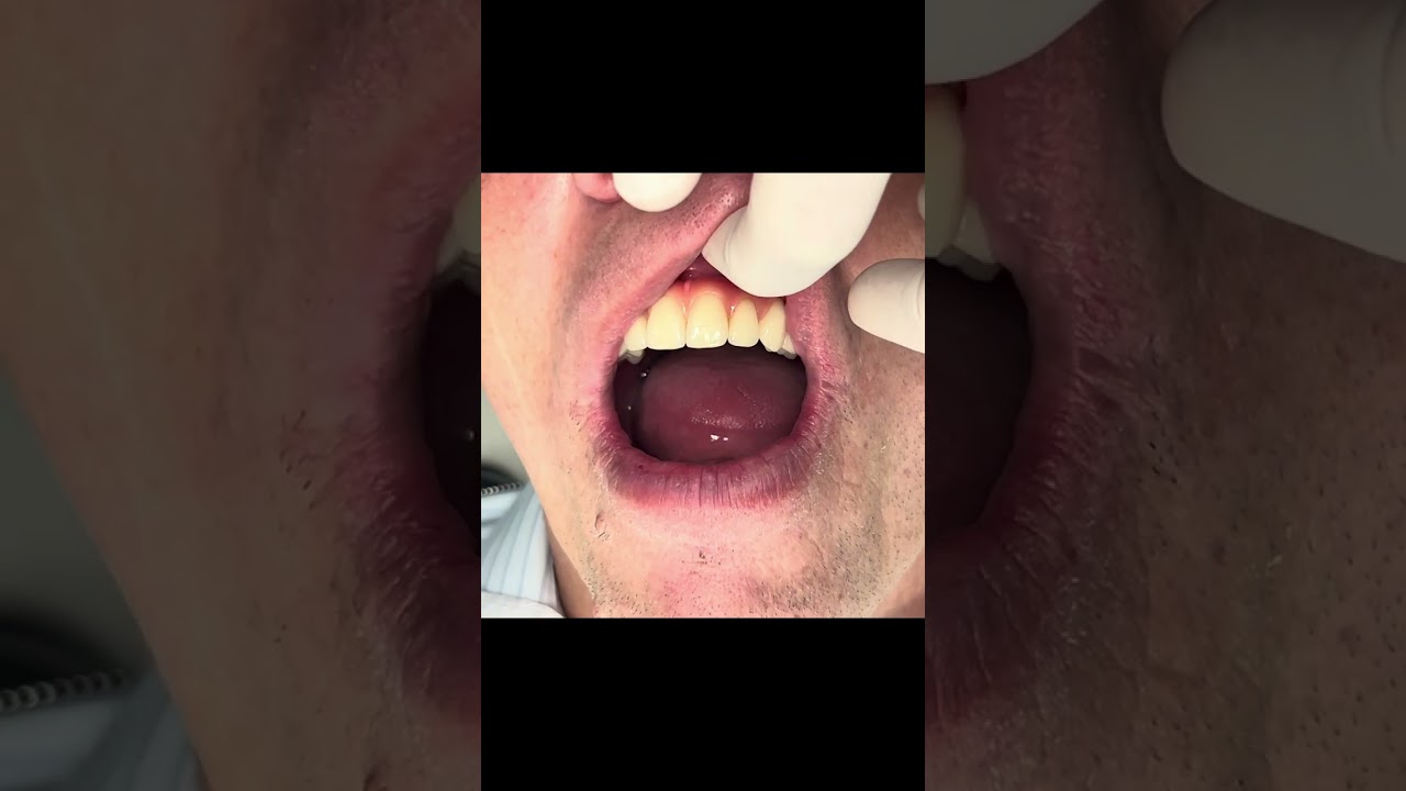 Limpeza da prótese protocolo sobre implantes dentários.