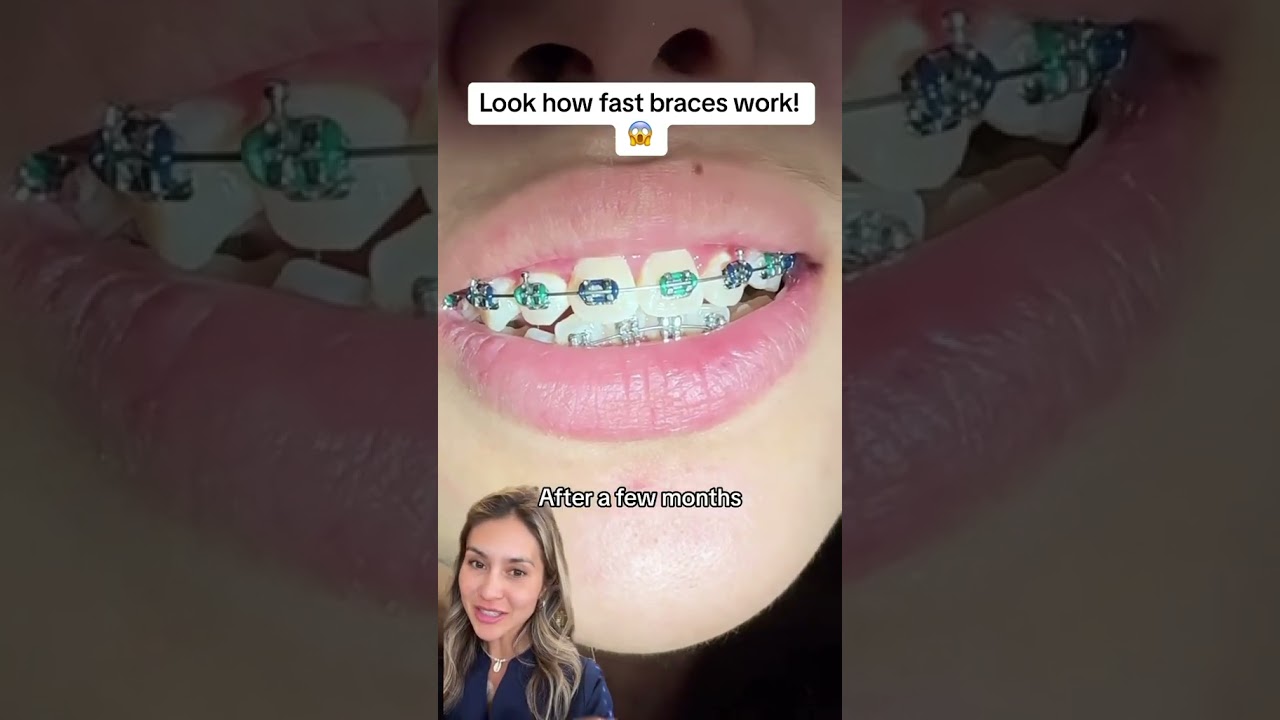 Look At How Fast Braces Work #dentist #braces