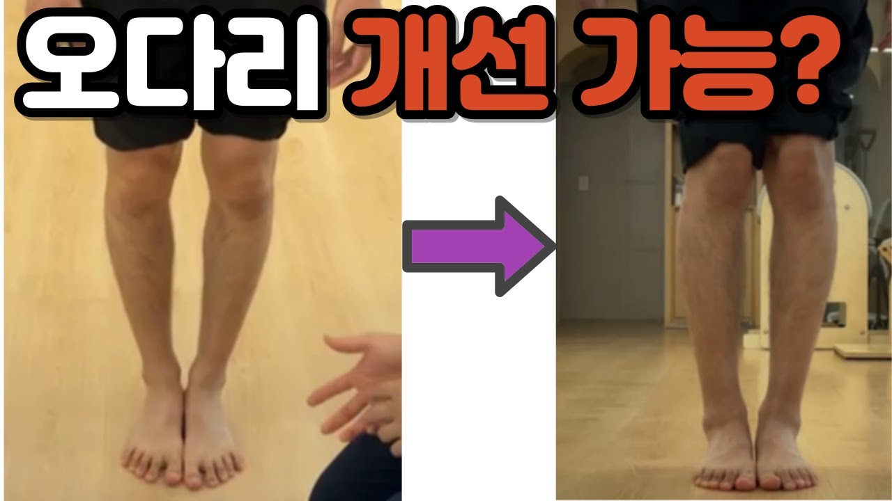 오다리는 개선이 가능할까? 휜다리 교정 / 엑스다리 오다리 외반슬 내반슬 발목통증 개선 과정