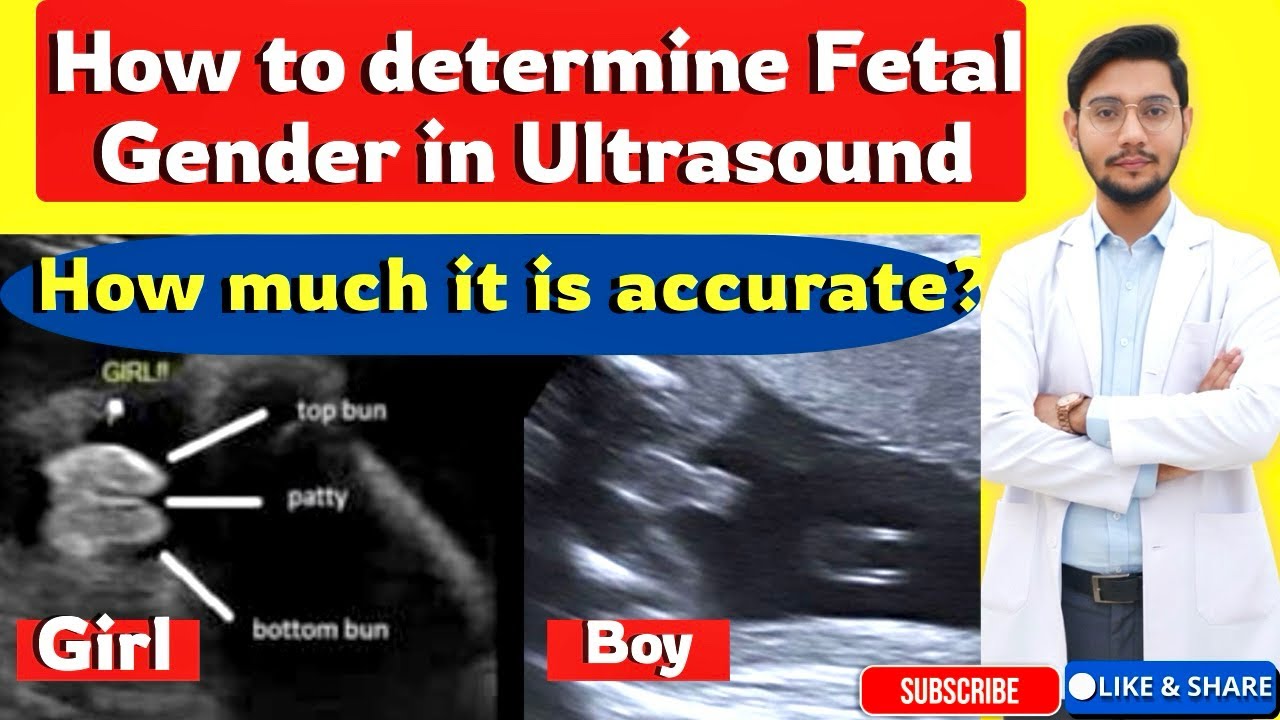 How to determine Fetal Gender in USG|| How much it is accurate ||Accuracy depends on? Is it illegal?