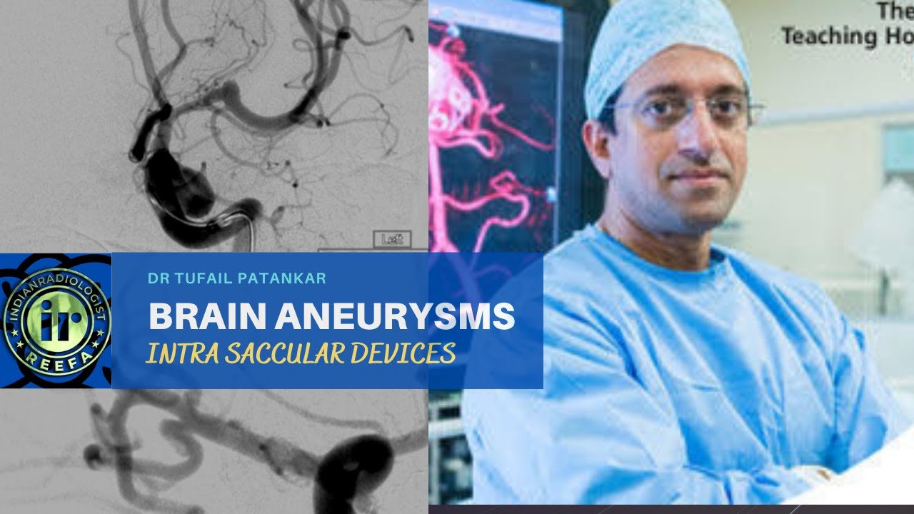 BRAIN ANEURYSMS | INTRA SACCULAR DEVICES | DR TUFAIL PATANKAR | ANEURYSM COILING | NEWER TECHNIQUES
