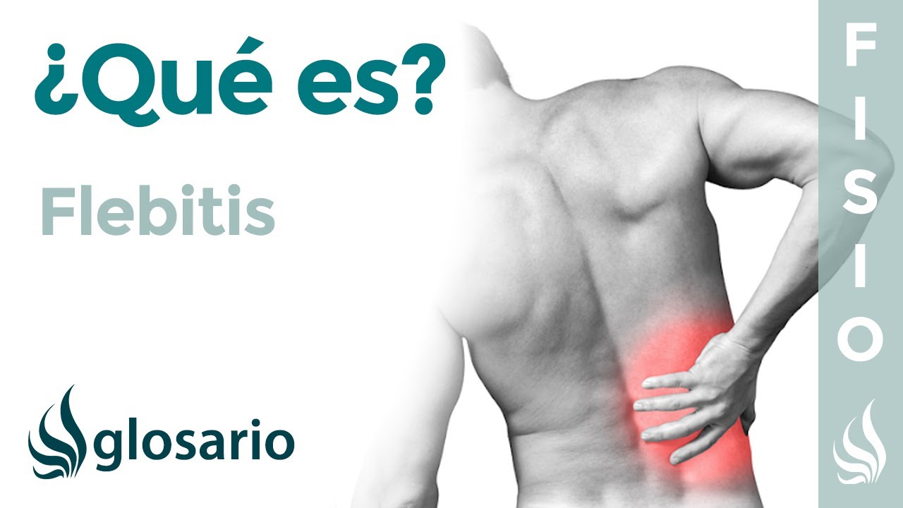 FLEBITIS | Qué es, qué afecta, síntomas, signos clínicos, causas y tratamiento fisioterapéutico