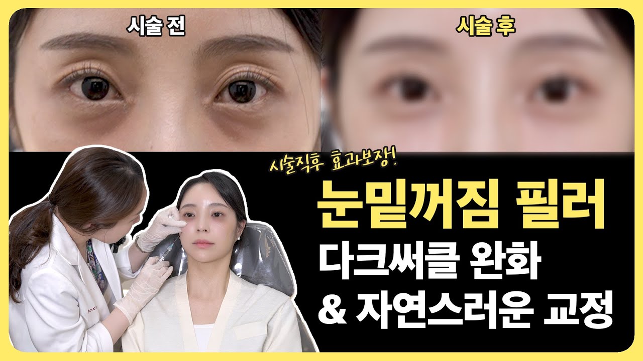 눈밑꺼짐,다크써클이 고민이라면?😉자연스러운 눈밑필러⏩️시술과정, 디자인, 시술직후 공개