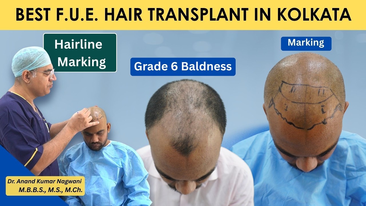 Best F.U.E. Hair transplant in Kolkata|Hairline marking by Dr Nagwani| Grade 6  Baldness|Cosmo Aid