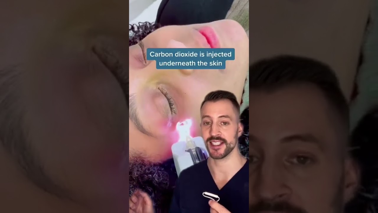 Carboxytherapy for under eye dark circles?!