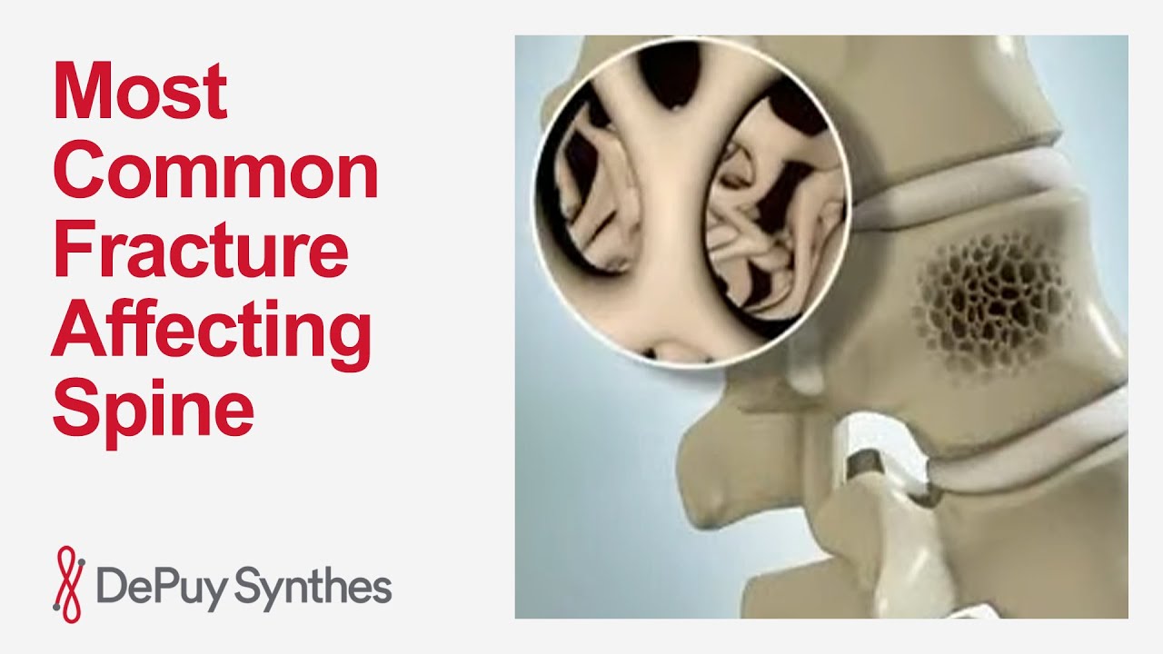 Что такое компрессионный перелом позвонка? Основные причины и лечение | DePuy Synthes