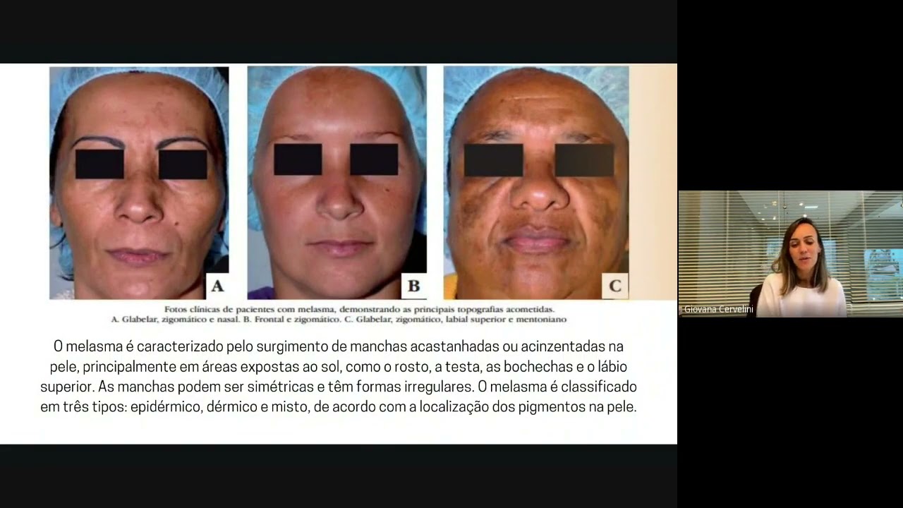Tema: Influência do Intestino e da Disbiose no Melasma | Grupo de Estudos Injetáveis na Estética