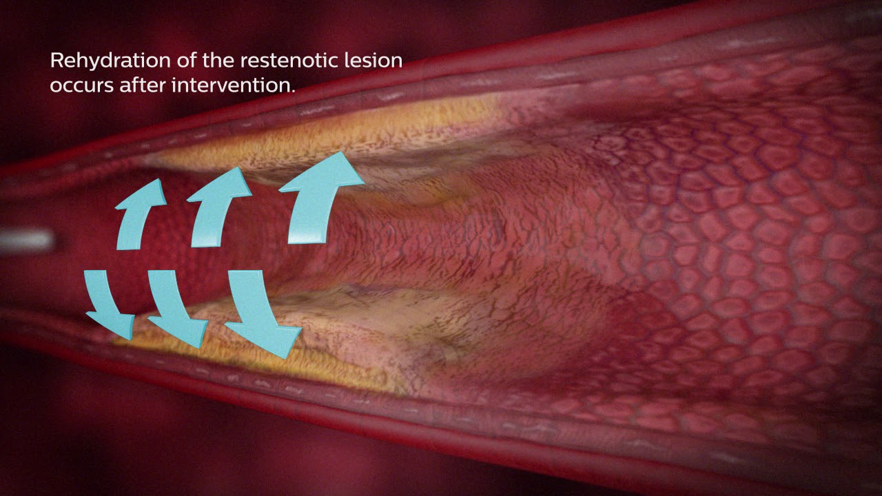 Restenosis Animation