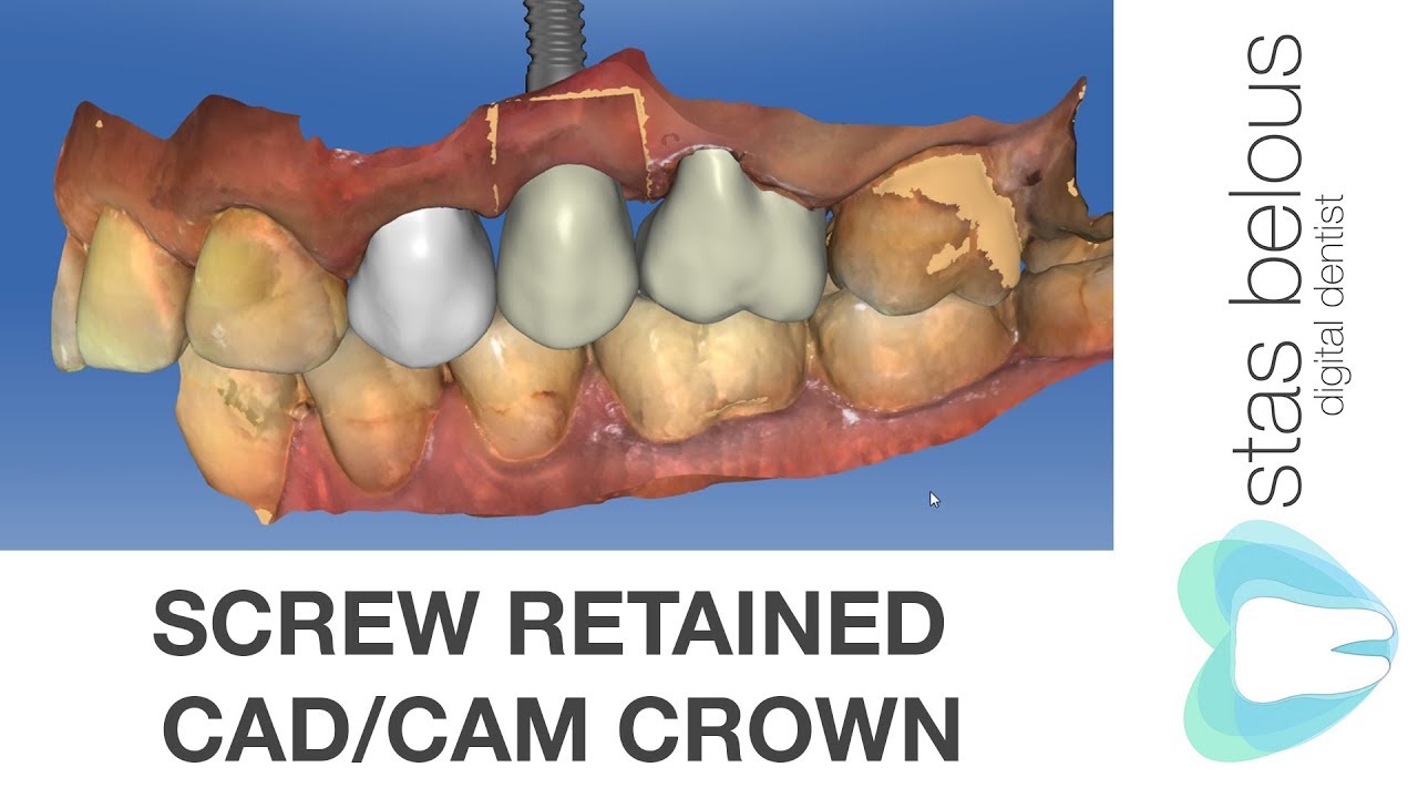 Screw retained Ankylos implant Cad/cam Cerec omnicam Crown Emax Hole block A14S Stas Belous