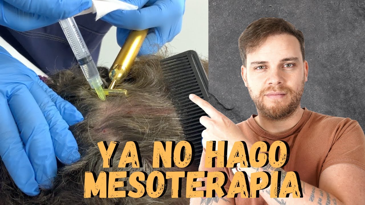 &iquest;POR QU&Eacute; YA NO HAGO MESOTERAPIA CAPILAR? PLASMA/DUTASTERIDE