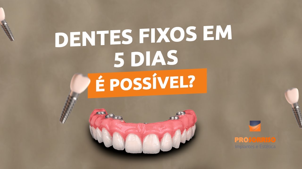 CARGA IMEDIATA - DENTES FIXOS EM 5 DIAS, &Eacute; POSS&Iacute;VEL?