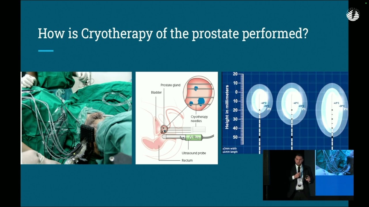 Cryotherapy of the Prostate | MedTech Malta 2024