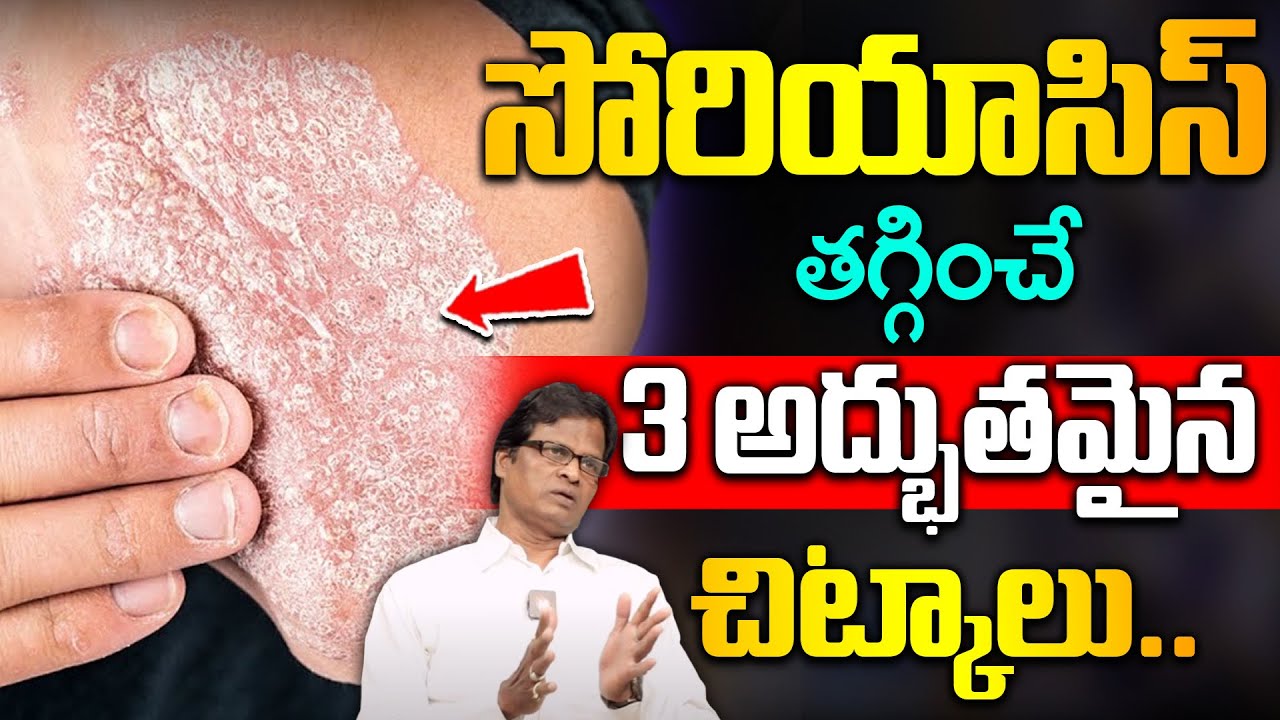 How to Prevent Psoriasis: The Best 3 Remedies for Psoriasis and Treatment | Dr SA Kumar