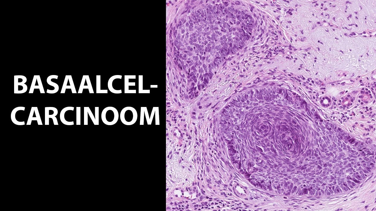 Basaalcelcarcinoom, de meest voorkomende kanker, maar niet gevaarlijk!